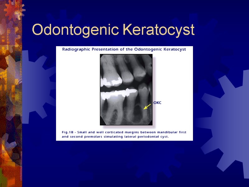 Odontogenic Keratocyst